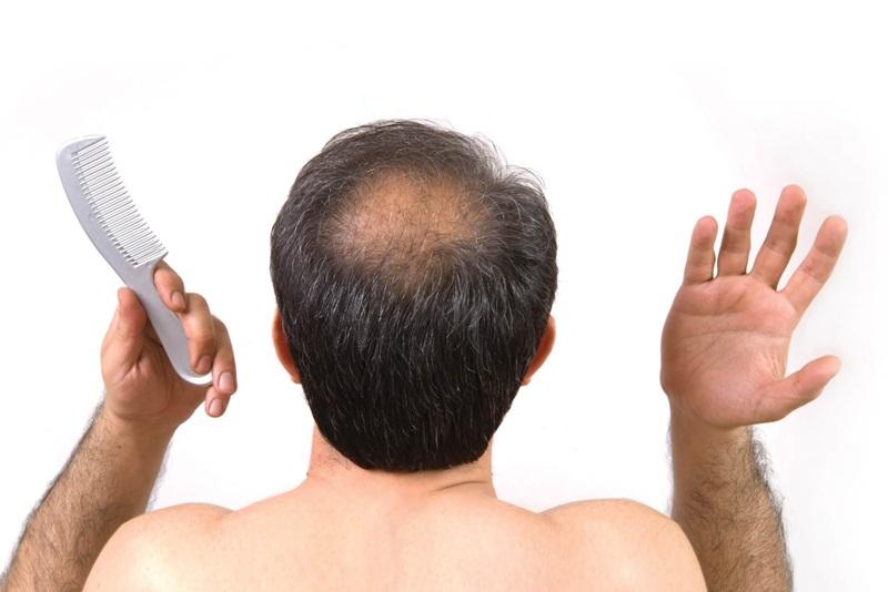 Quan điểm của chuyên gia y tế về vấn đề rụng tóc nhiều và thiếu chất
